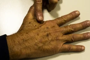 Foto: Desinformação sobre câncer de pele afeta diagnóstico - Foto: Marcello Casa