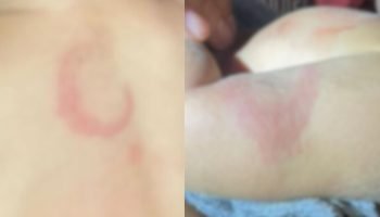 Hematomas apresentados no bebê após a agressão no fim de semana. — Foto: Hematom