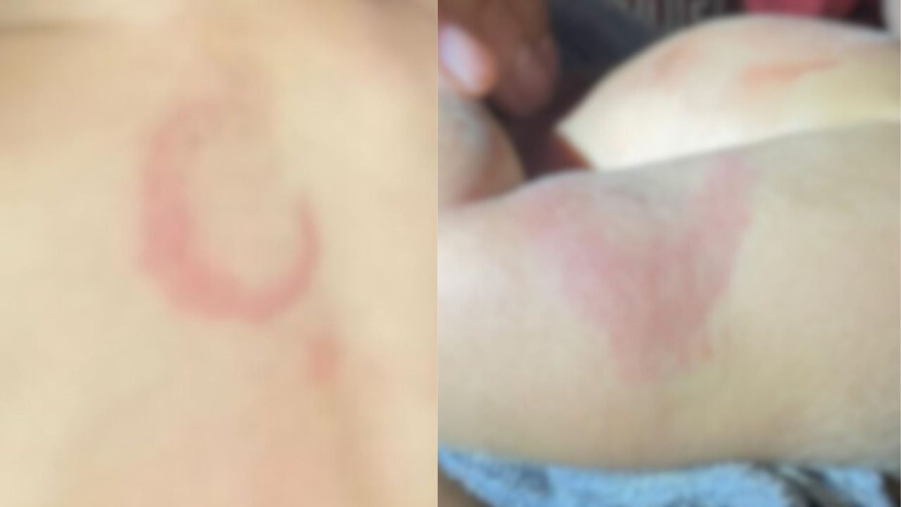 Hematomas apresentados no bebê após a agressão no fim de semana. — Foto: Hematom