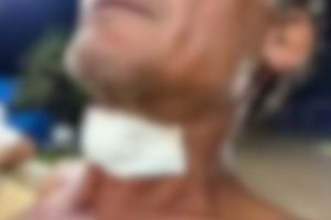 Vítima com curativo no pescoço após o atendimento no hospital. — Foto: Vítima co