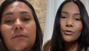Chaiany mostra antes e depois de procedimento estético. (Foto: Reprodução/Gshow)