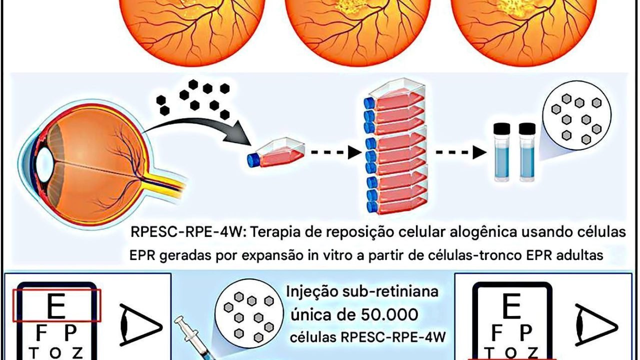 Cientistas utilizam células-tronco para restaurar visão em pacientes com degeneração macular